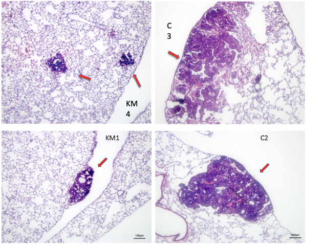 A picture of lungs with metastases